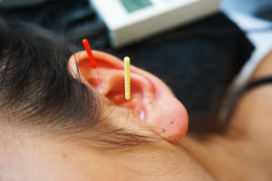 oor acupunctuur 1