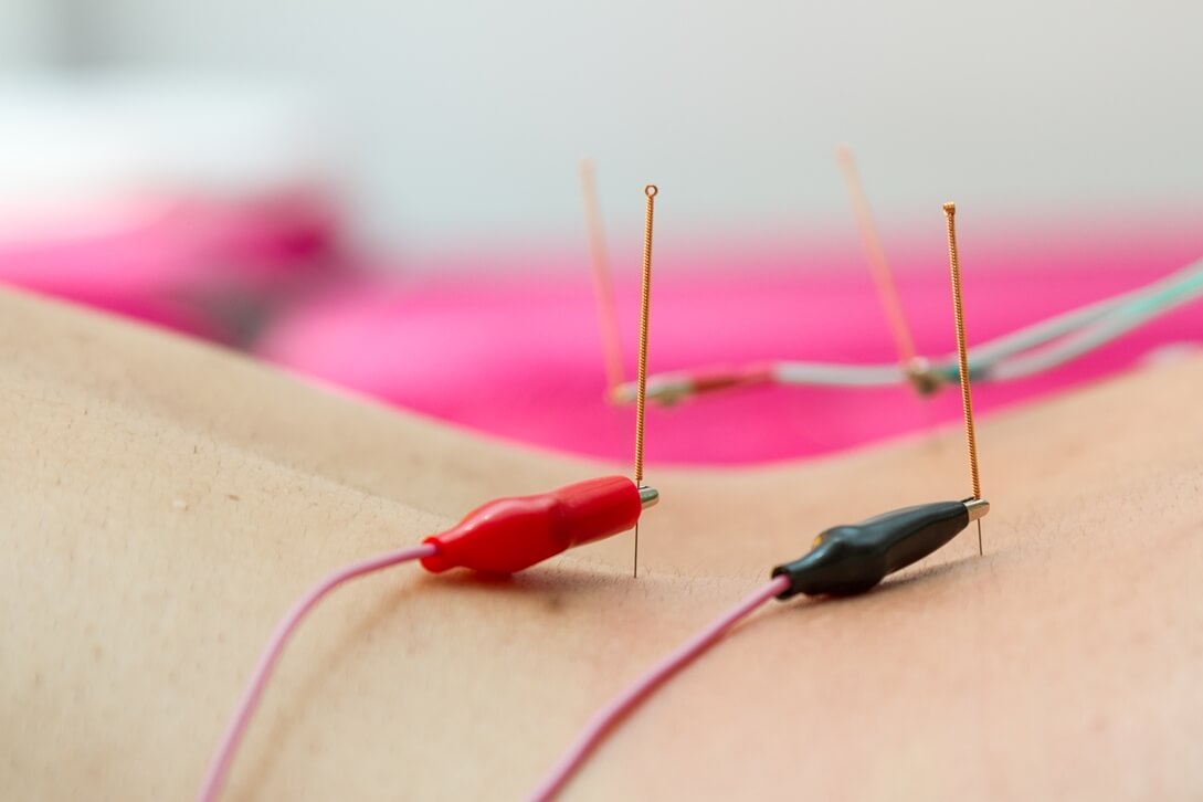elektro acupunctuur
